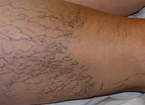 Causas de varices nas pernas